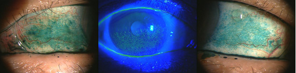 図４．シェーグレン症候群（SS: Sjogren’s syndrome）（角膜（中央）