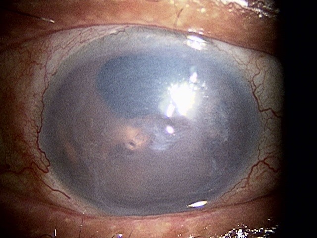 全層角膜移植術前