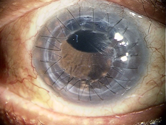 全層角膜移植の術後