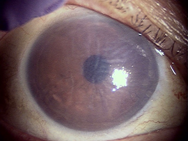 角膜内皮移植術前