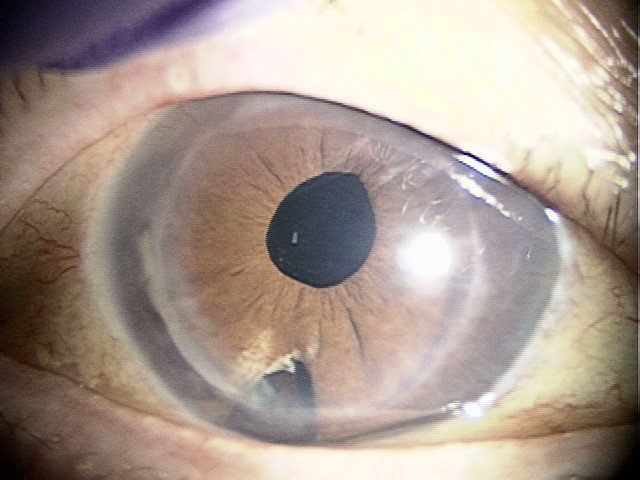 角膜内皮移植の術後