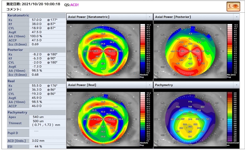 全層角膜移植後の角膜形状