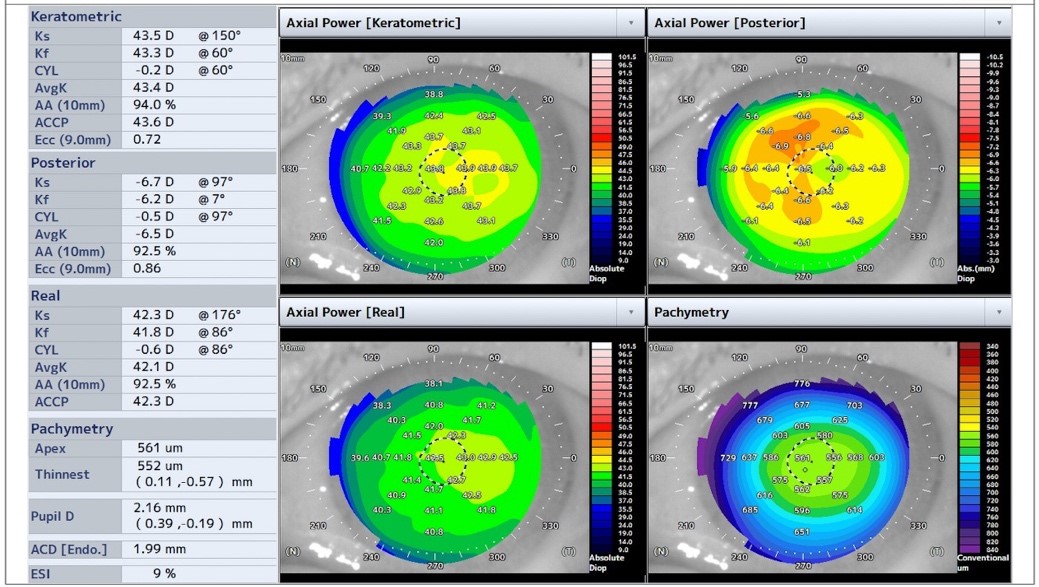 角膜内皮移植後の角膜形状